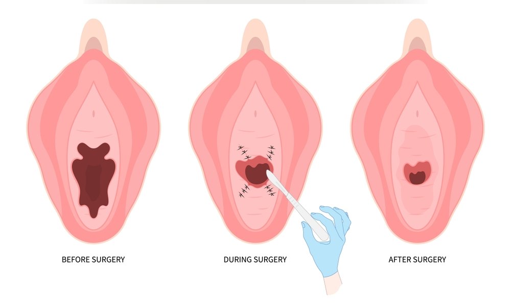 Vaginal Rejuvenation.jpg